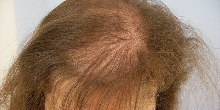 Androgenic Alopecia Pada Wanita1